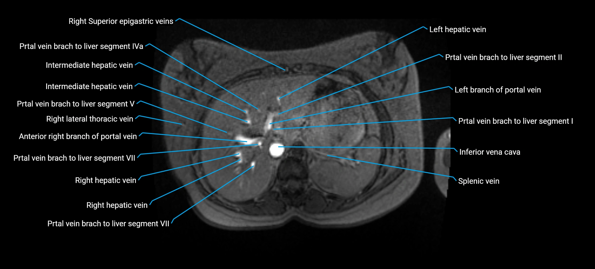 MRV abdomen pelvis & lower limb axial cross sectional anatomy labelled MRI image 37 (1).webp
